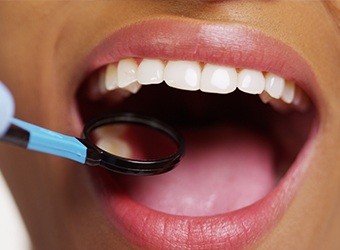 smile with metal-free restorations