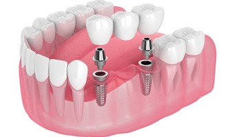a 3D depiction of a dental implant bridge