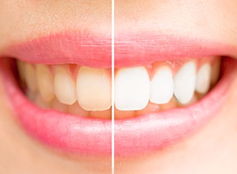 before and after teeth whitening