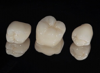 Three different types of dental crowns used to protect weakened teeth