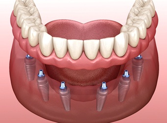 Implant Dentures