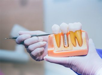 a dentist holding a plastic model of a dental implant