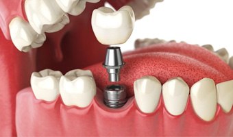 a 3D illustration of a single dental implant and crown