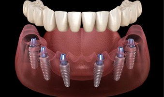 a 3D illustration of an implant denture