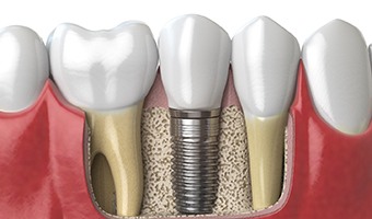 Close-up of dental implant in Prince Albert in healthy jawbone