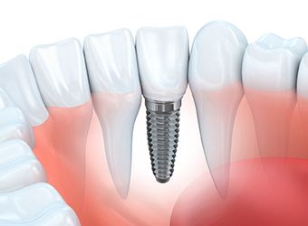 Diagram of dental implants in Prince Albert