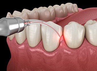 a 3D illustration of soft tissue laser dental treatment