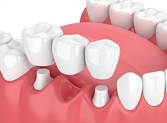 illustration of dental brudge