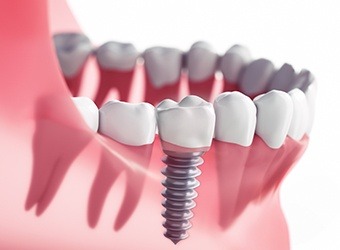 illustration of implant in gums