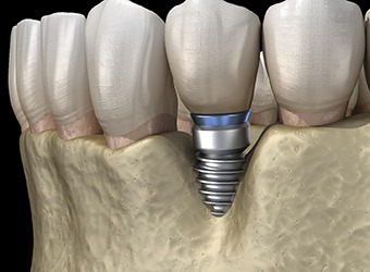 Illustration of failed dental implant in Prince Albert, SK after bone loss