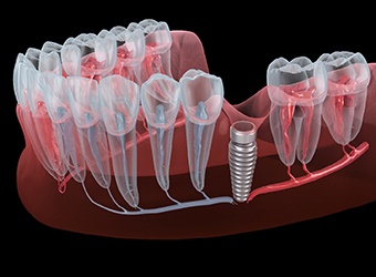 Illustration of a failed dental implant in Prince Albert, SK