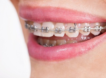 traditional braces