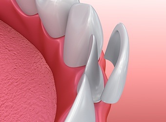 illustration of veneer