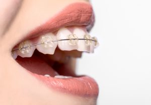 braces in prince albert