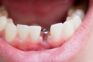 single tooth implant emerges from the jaw