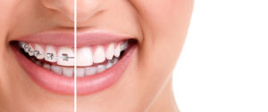 woman's smile with braces