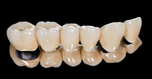 tooth colored dental bridge