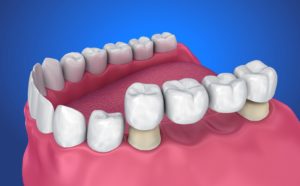 model of dental bridge