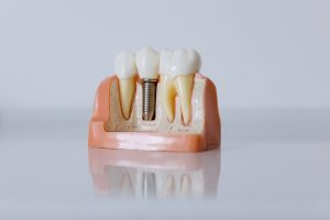 Model of single unit dental implant